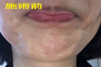 あごボトックス