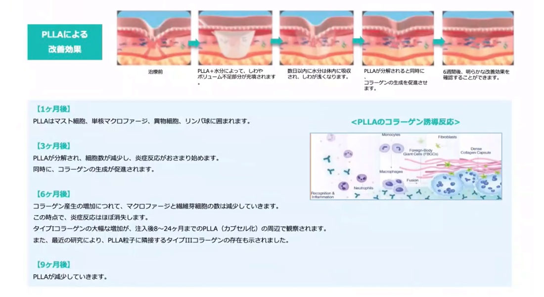 ポテンツアの瘢痕・傷跡治療の図2