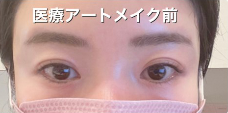 アートメイク（眉）の症例