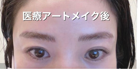 アートメイク（眉）の症例
