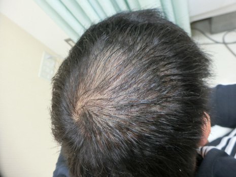 アートメイク（ヘアライン・生え際）