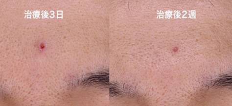 施術手順2