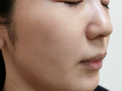 新脂肪溶解注射 症例3