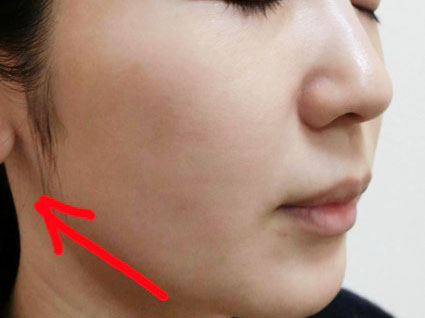 新脂肪溶解注射 症例4