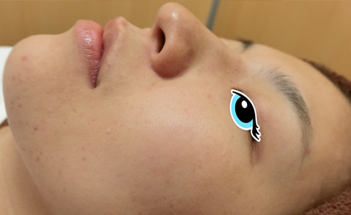 ニキビや毛穴の治療③