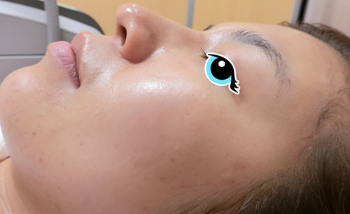 ニキビや毛穴の治療④